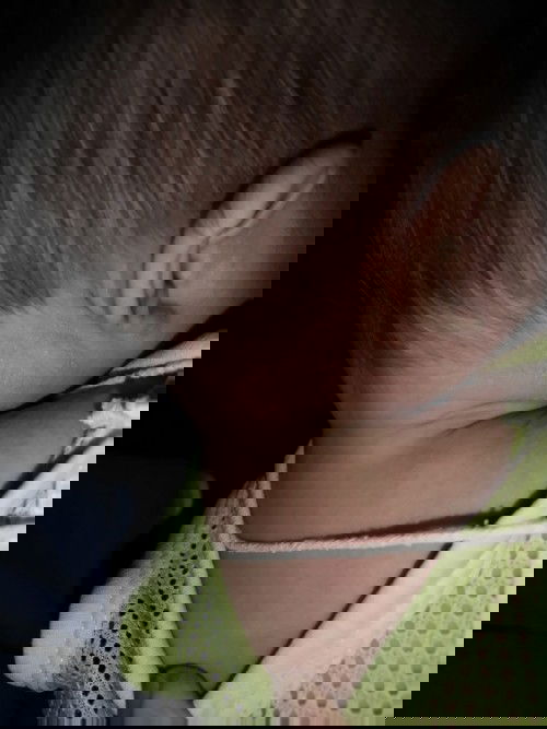 ไม่รู้ว่าเป็นอะไรคล้ายกากน้ำนมมันเป็นผื่นด่างๆไปหาหมออนามัยเค้าบอกเป็นผดร้อนลูกใครเคยเป็นบ้างคะ