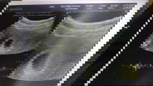 Bagaimana baca hasil USG?