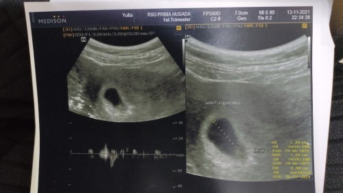 Bagaimana baca hasil USG?