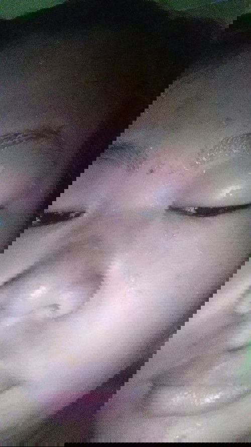 Bun kenapa ya mata dan leher saya gatel dan jadi pada bengkak gini