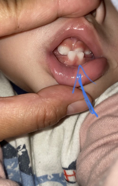 Gigi anak Underbite