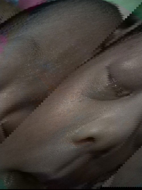 Mata bayi baru lahir bengkak,nanah,berdarah karena awal belekan