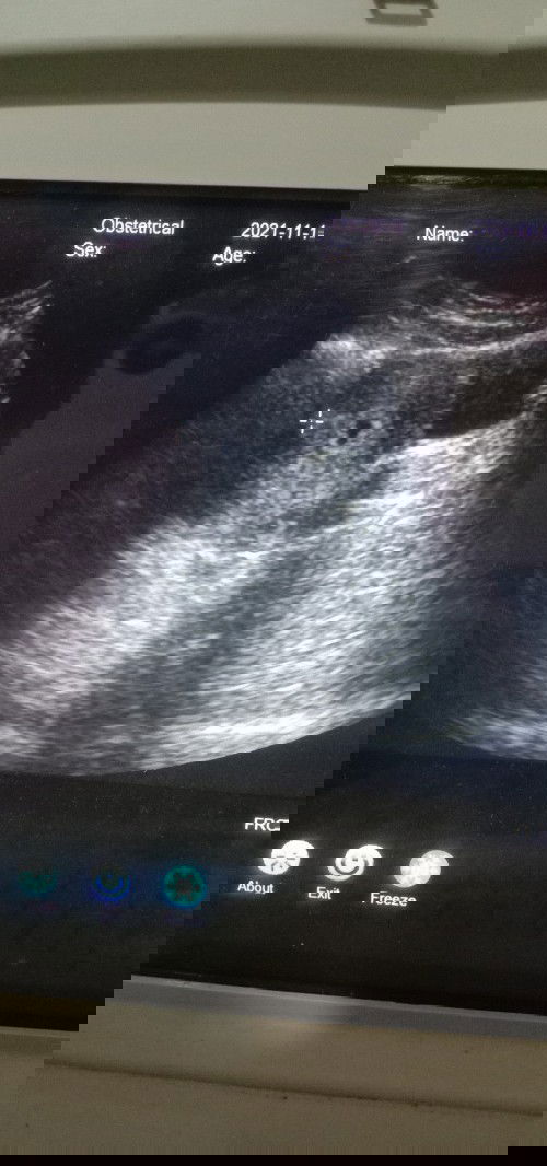 Perkiraan jenis kelamin