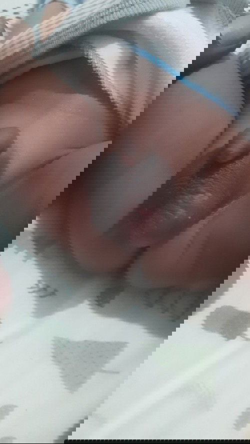 Iritasi pada kelamin bayi