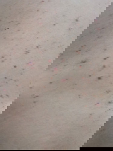 Pangangati habang buntis