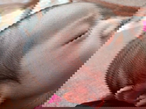 Nổi đỏ trên da đầu,mặt, sau lưng