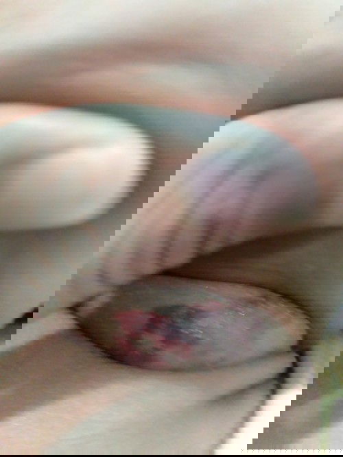 คอเป็นแบบนี้่ ควรใช้ยาอะไรดีคะ เคยพาไปอนามัย ได้ยามาทา ไม่หาย มีบ้านไหนเคยเป็นแนะนำหน่อยค่ะ