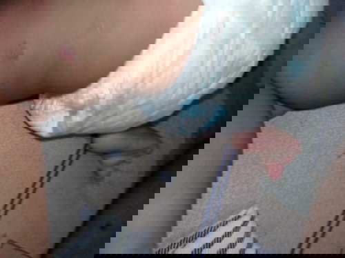 Dikasih salep apa ya , sdh periksa ke puskesmas dikasih salep hydrocortison tapi ndak sembuh"