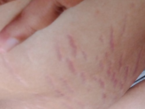Menghilangkan Stretch Mark!!