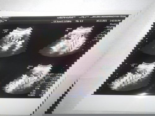 Hasil USG nya ada yang bisa baca bun?