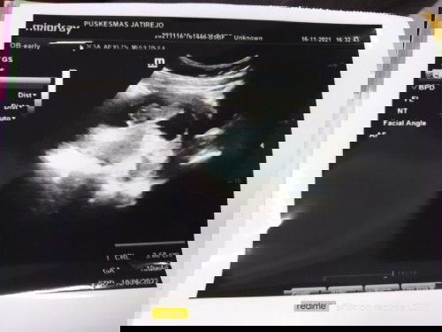 Beda hpl bidan dan usg