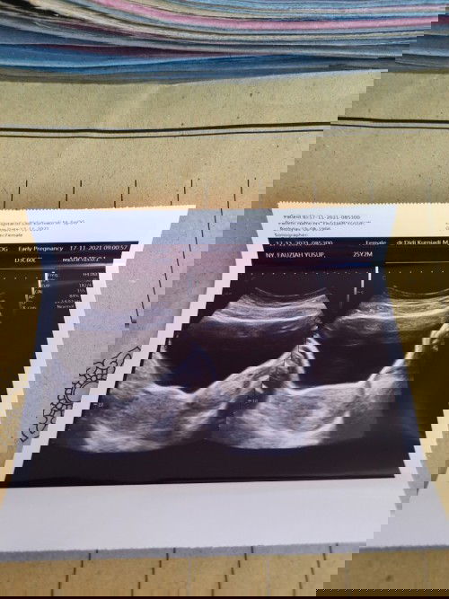 UK 5 week di usg masih kosong