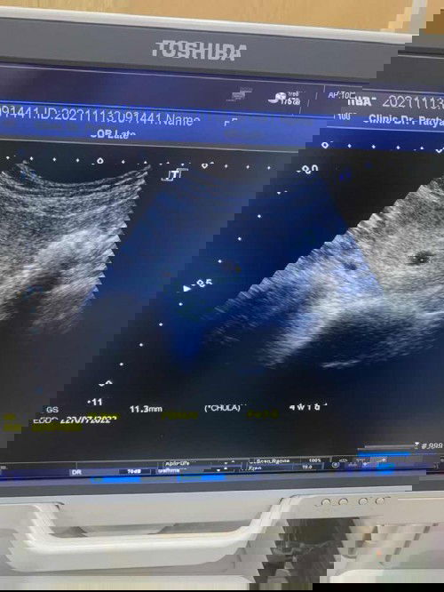 นับวันประจำเดือนมาครั้งสุดท้ายอายุครรภ์ได้7wแต่หมอซาวท้องให้บอกพึ่งได้4w เราควรจะทำยังใงกับข้อสงสัยนี้คะว่าทำไมไม่ตรงกัน