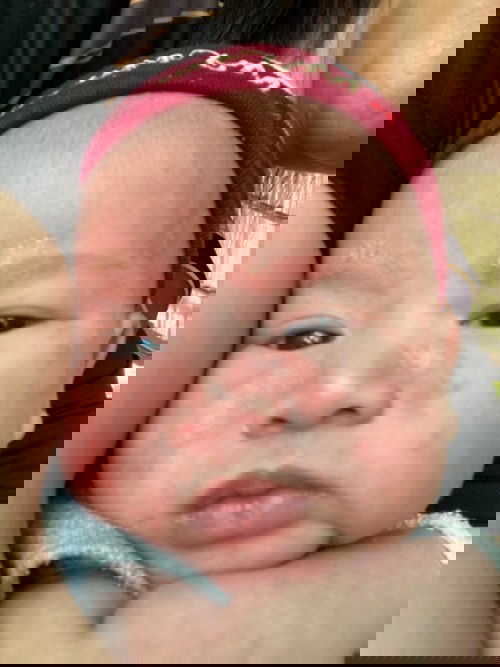 น้องเป็นผื่นแบบนี้มาเป็นเดือนแล้วค่ะ