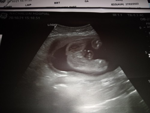 อยากถามแม่ๆว่าผู้หญิงหรือผู้ชายคะ รูปตอน22วีคค่ะ