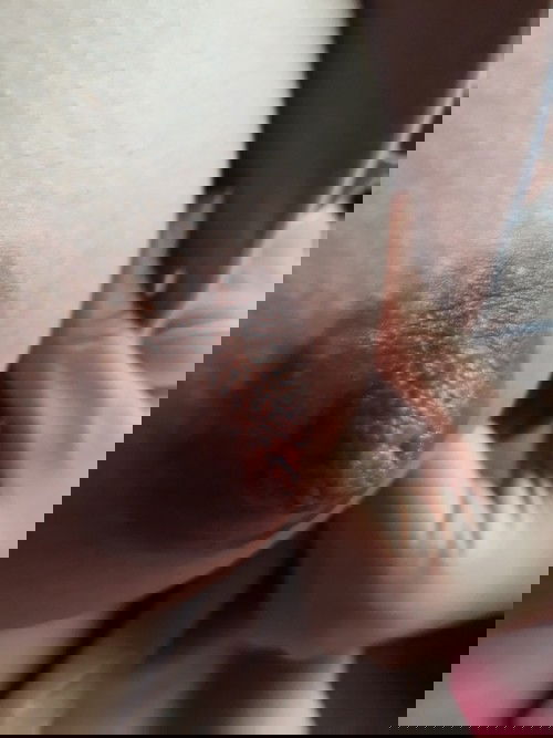 E bị nổi cục cứng đầu ti . Sữa vẫn chảy bt.  Nhưng núm đen cứng nên con e k chịu bú ạ.đã chườm nóng