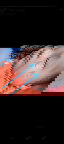 Bercak putih di muka bayi