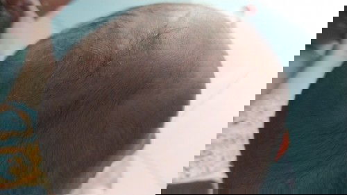 Putih putih di kulit kepala bayi 10 bulan