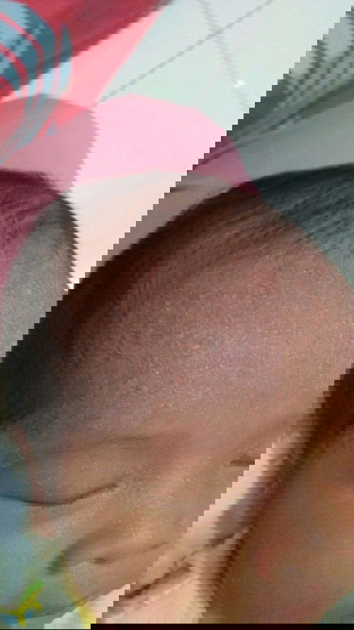 Biang keringat atau keringet buntet