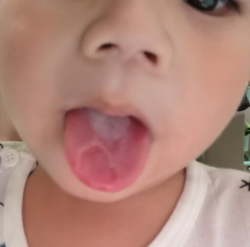 Toddler's tongue