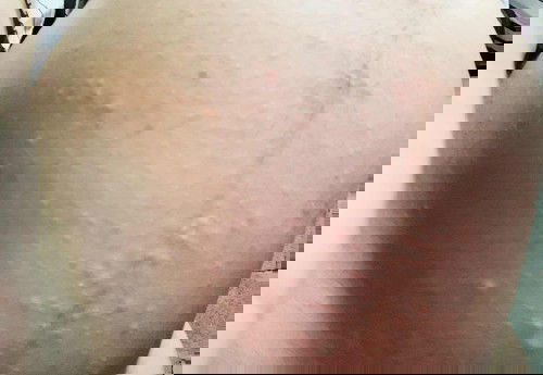 แม่ๆคนไหนคันเวลาดึกๆบ้างคะ