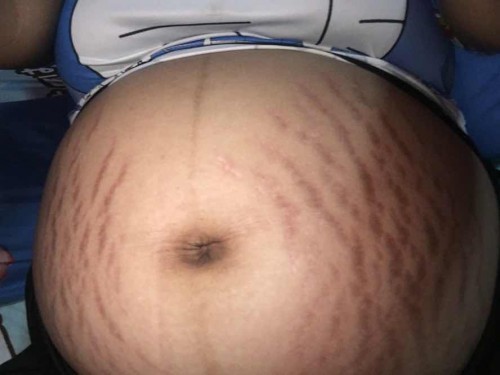 ช่วยแนะนำครีมทาท้องหน่อย