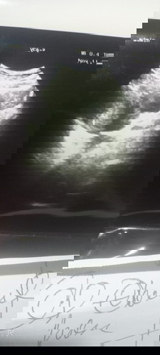 Hasil usg 11 November 2021