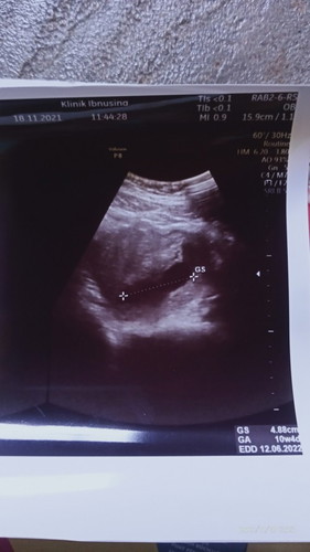 Bunda saya ingin bertanya kehamilan 10minggu usg masih kantongnya aja janinnya belum ada normal kah