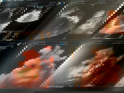 Hitungan usia ke hamilan bikin galau