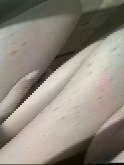 Da nổi mụn có chị nào bầu bị nổi như em k ạ