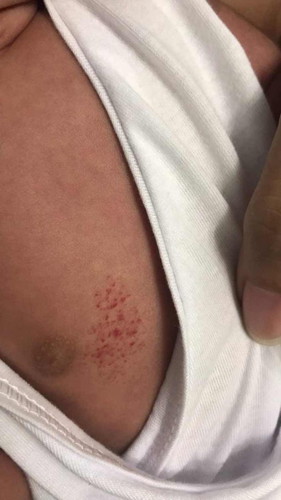Red spots in chest parang namuo dugo