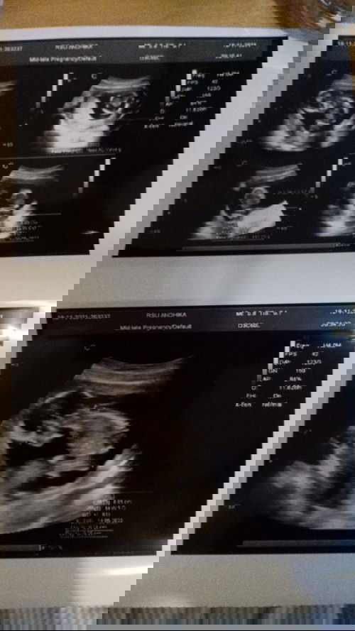 Plasenta berada di bawah