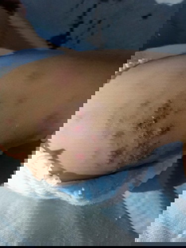 BABY RASHES