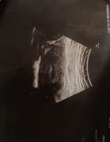 Scanning awal kehamilan