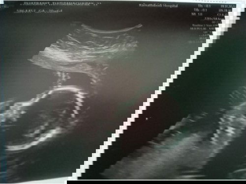 รกเกาะต่ำแอบเครียด