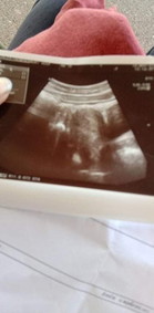 แท้งคุกคาม