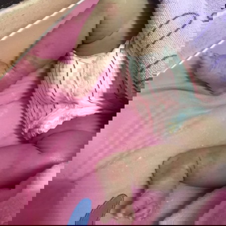 ผื่นแดงที่แขนและขาเหมือนมดกัด