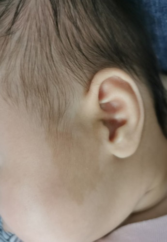Coffee patches on baby face