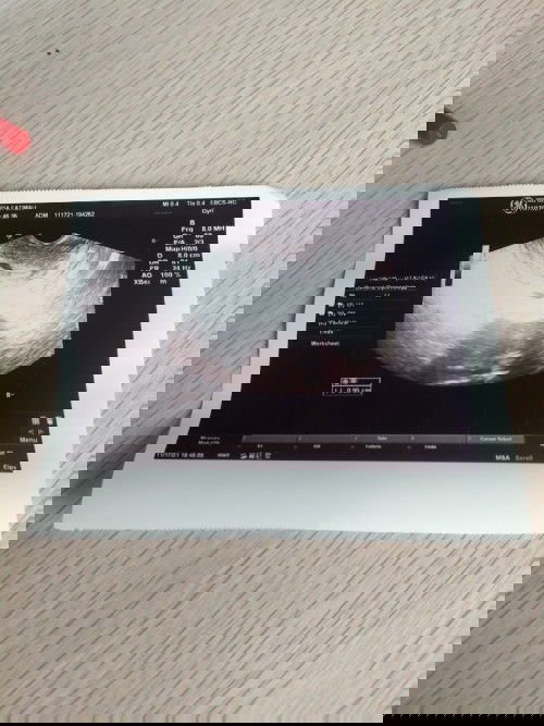 Bentuk kantong janin tidak bulat.