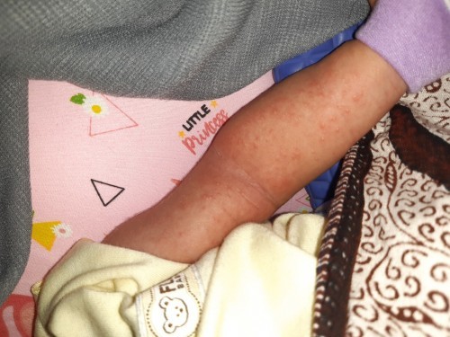 Bintik" merah d kulit