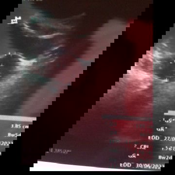 Hpl berbeda usg k 1 dan k 2