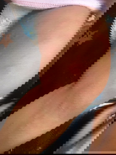 Biduran belum sembuh