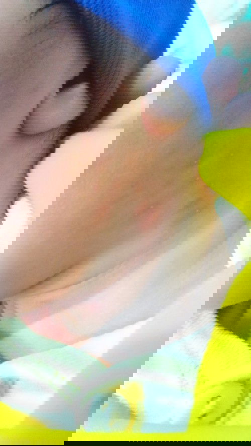 merah merah pada kulit newborn