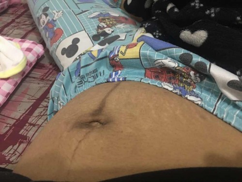 Ano magandang pantagal ng stretchmark mga momies ?