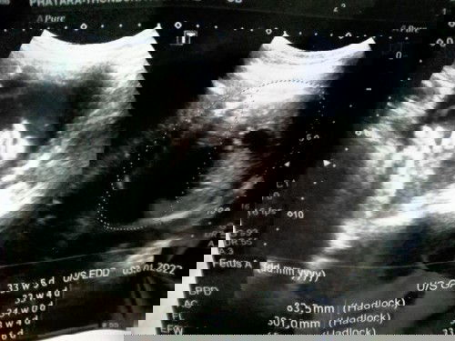 คุณแม่ว่าน้องปากใหญ่รึปากเล็กค่ะคุณหมอว่าน้องปากใหญ่น้องกำลังอ้าปากรึอะไร🤣🤣🤣