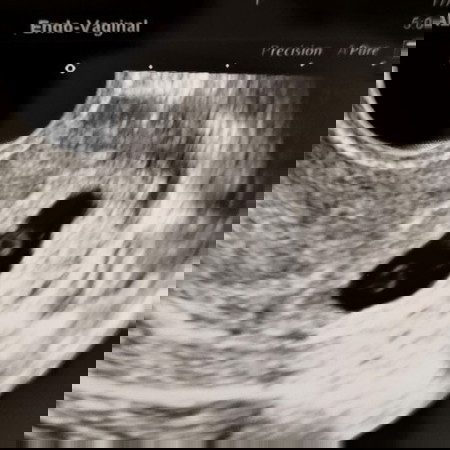 สอบถามคุณแม่ลูกแฝด หรือเคยซาวด์เจอถุงอาหารสองถุงค่ะ