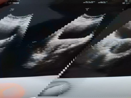 Apakah ada bunda yang mengalami? Karena dokter spog saya tidak menjelaskan apa apa 🥲