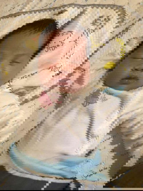 Trẻ sơ sinh bị lõm hai bên thái dương