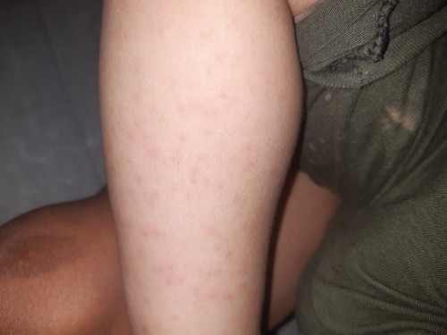 BABY SKIN PROBLEM