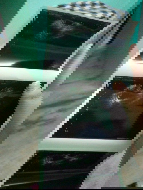 ไม่พบการฝังตัวของเด็ก